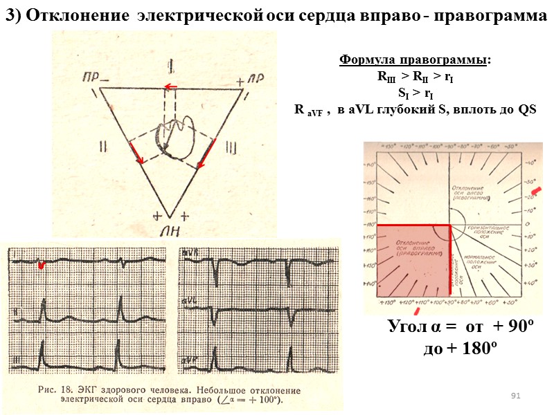 91 3) Отклонение  электрической оси сердца вправо - правограмма Формула правограммы: RIII >